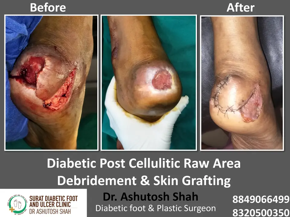 Diabetic Foot  PPT 3 checked by sir.pptx-104.webp